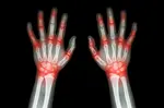 Medical Treatment for Chronic Rheumatoid Arthritis or Gout