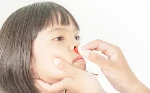 Child Nose Bleed / Epistaxis - Treatment AMDA SG Tel: 6694 1661