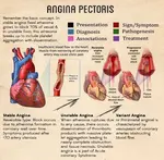 What is Angina? - AMDA SG Tel: 6694 1661
