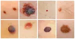 Treatment & Removal of Different Skin Moles at AMDA Tel: 6694 1661