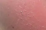 Dry Skin - Causes & Treatment