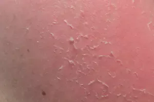 Dry Skin - Causes & Treatment