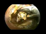 Ear Wax Removal