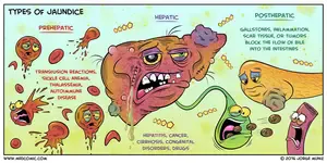 Liver Jaundice Types