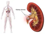 Kidney problems - Kidney stones