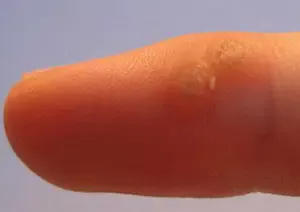 Wart Removal - AMDA International Peace Clinic