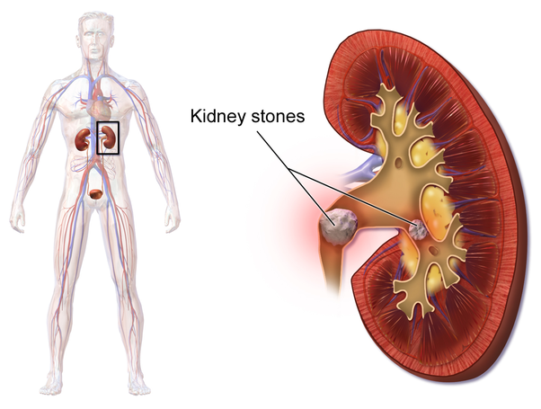 Kidney problems - Kidney stones