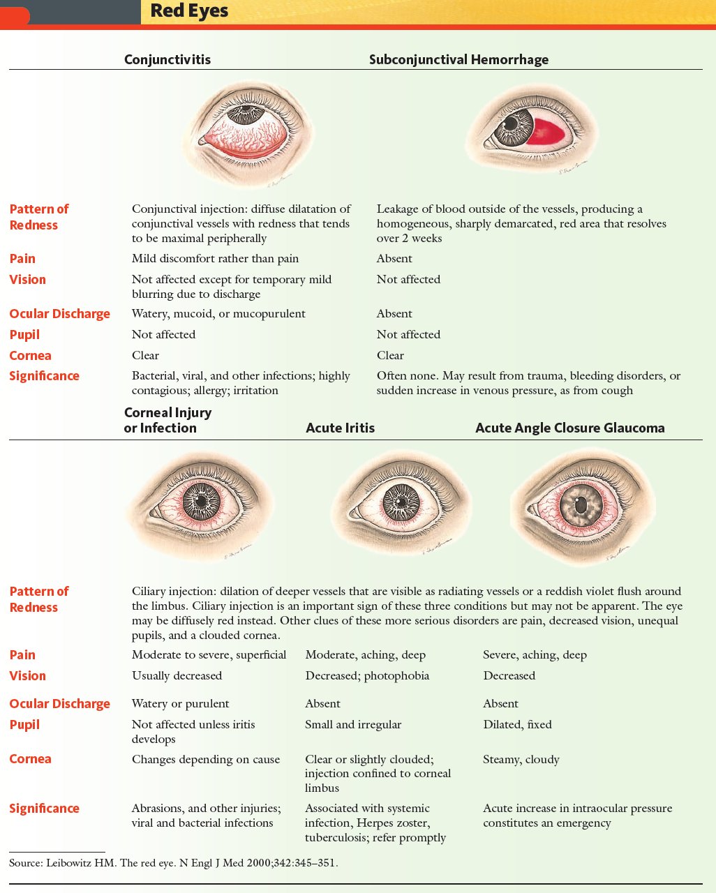Causes of Red Eye - Treatment at AMDA SG Tel: 6694 1661