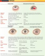 Causes of Red Eye - Treatment at AMDA SG Tel: 6694 1661