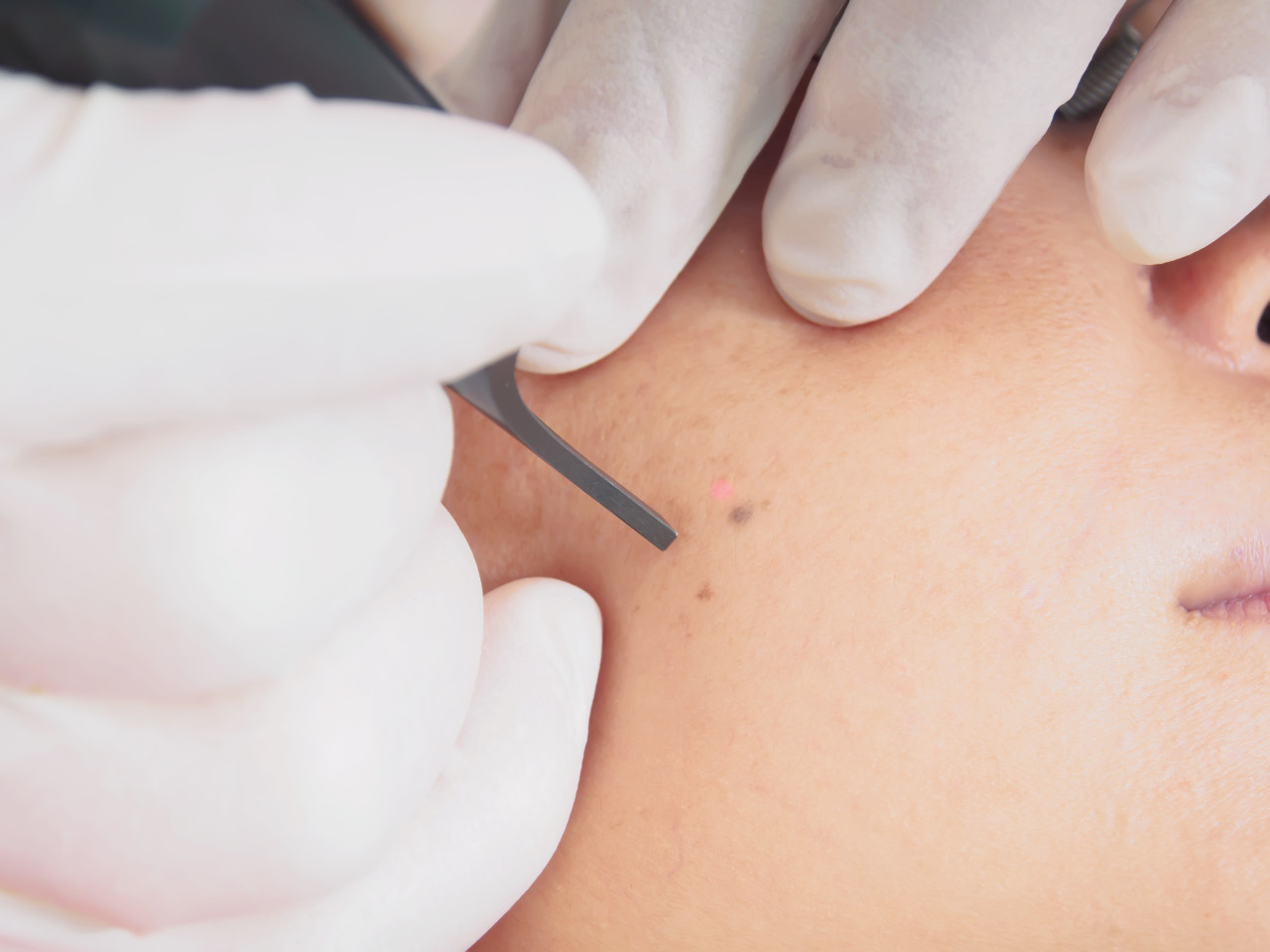 AMDA Clinic: Best Dermatology doctor medical treatment Laser procedure-skin resurfacing