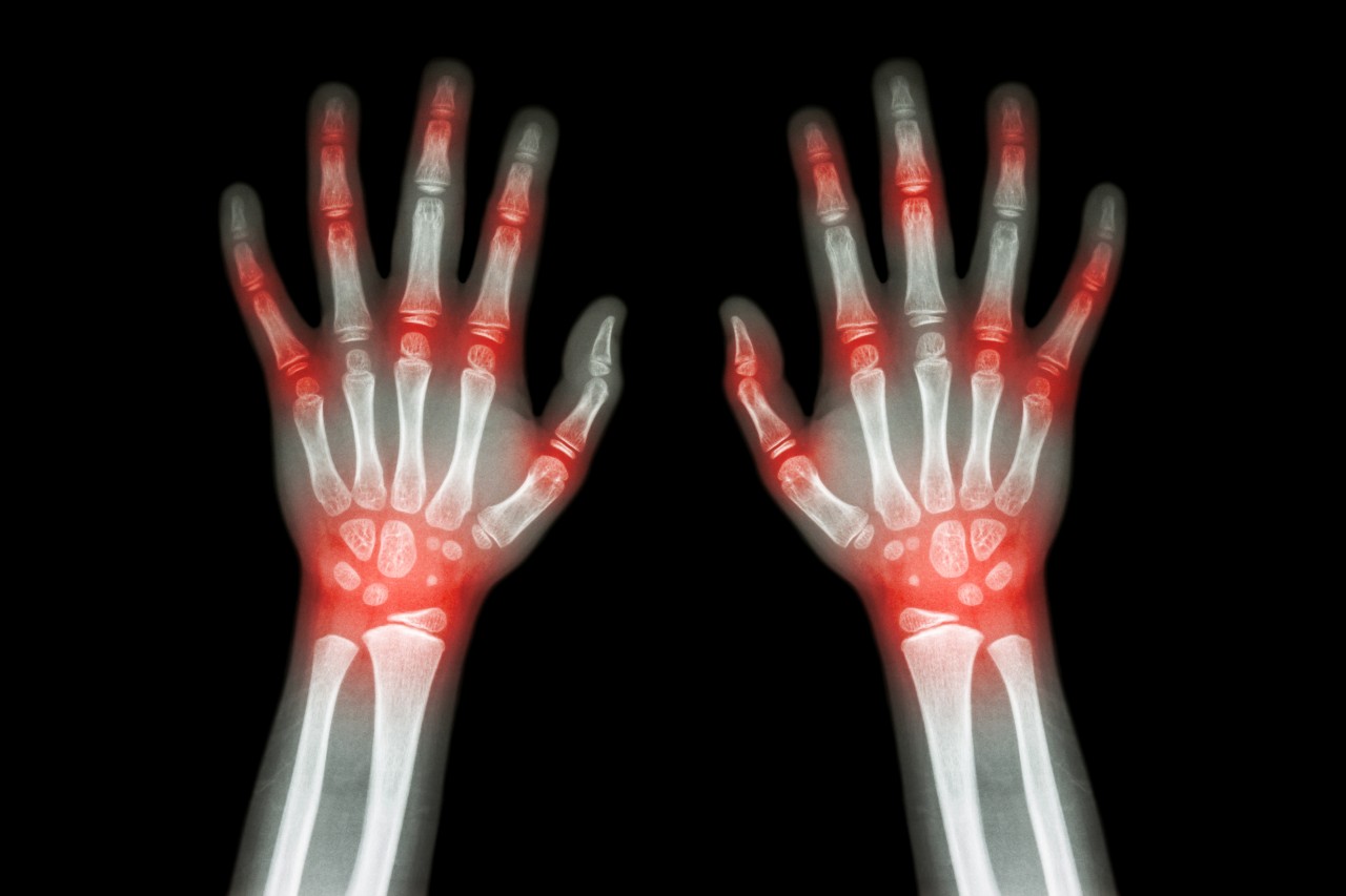 Medical Treatment for Chronic Rheumatoid Arthritis or Gout