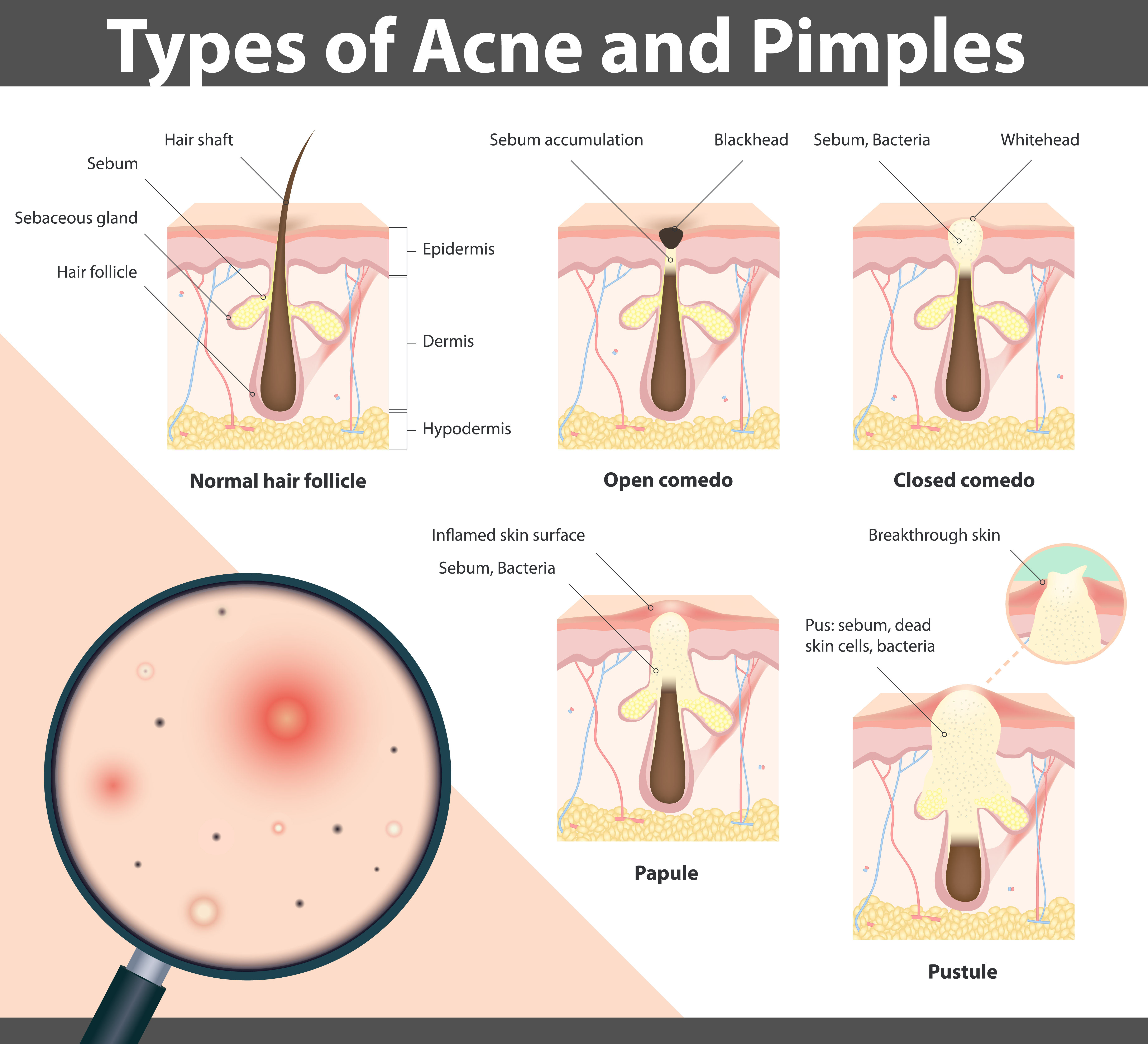 Acne Pimples Types - Treatment @ MDIMC