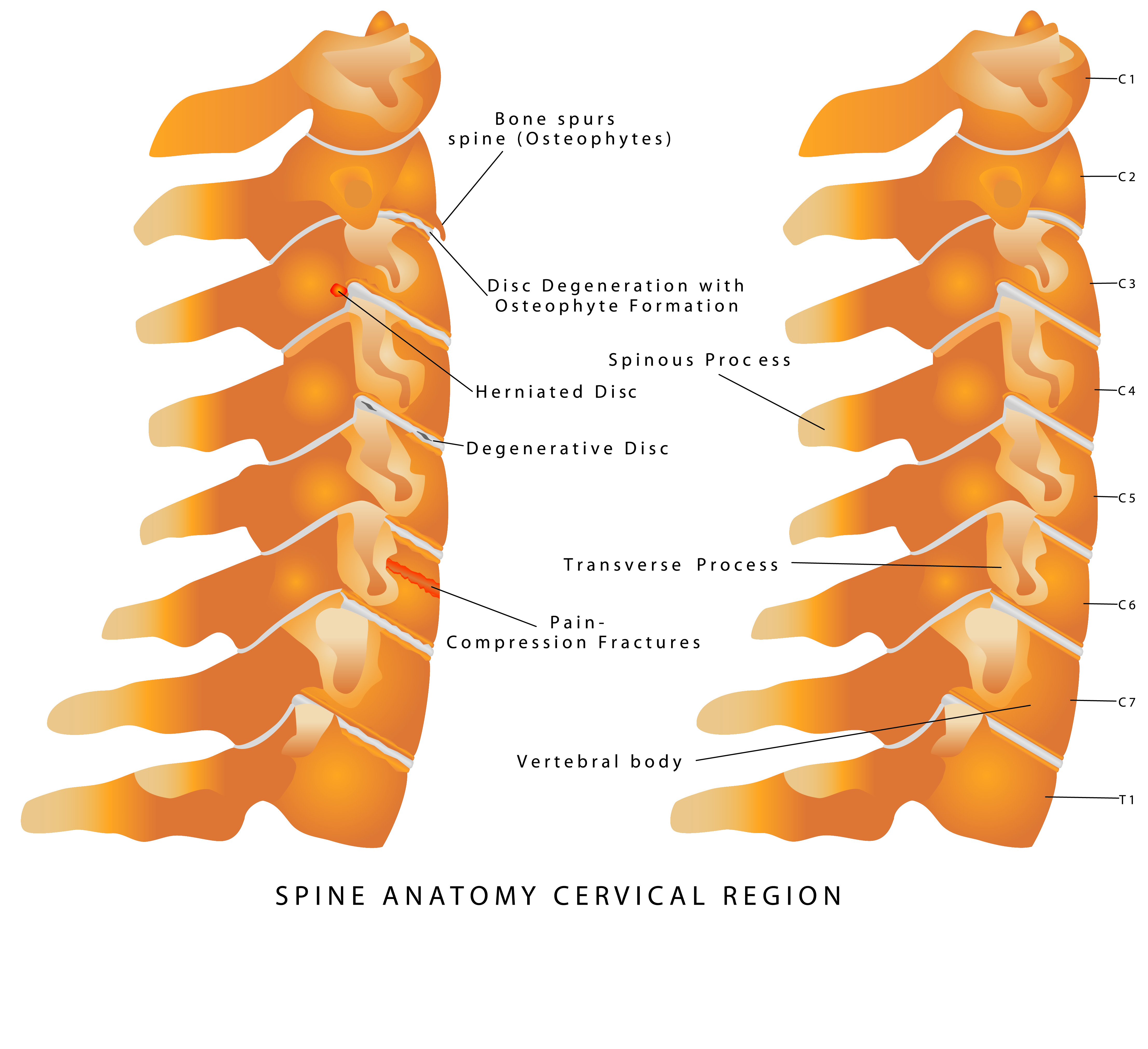 Back Pain - Spine Treatment @ MDIMC