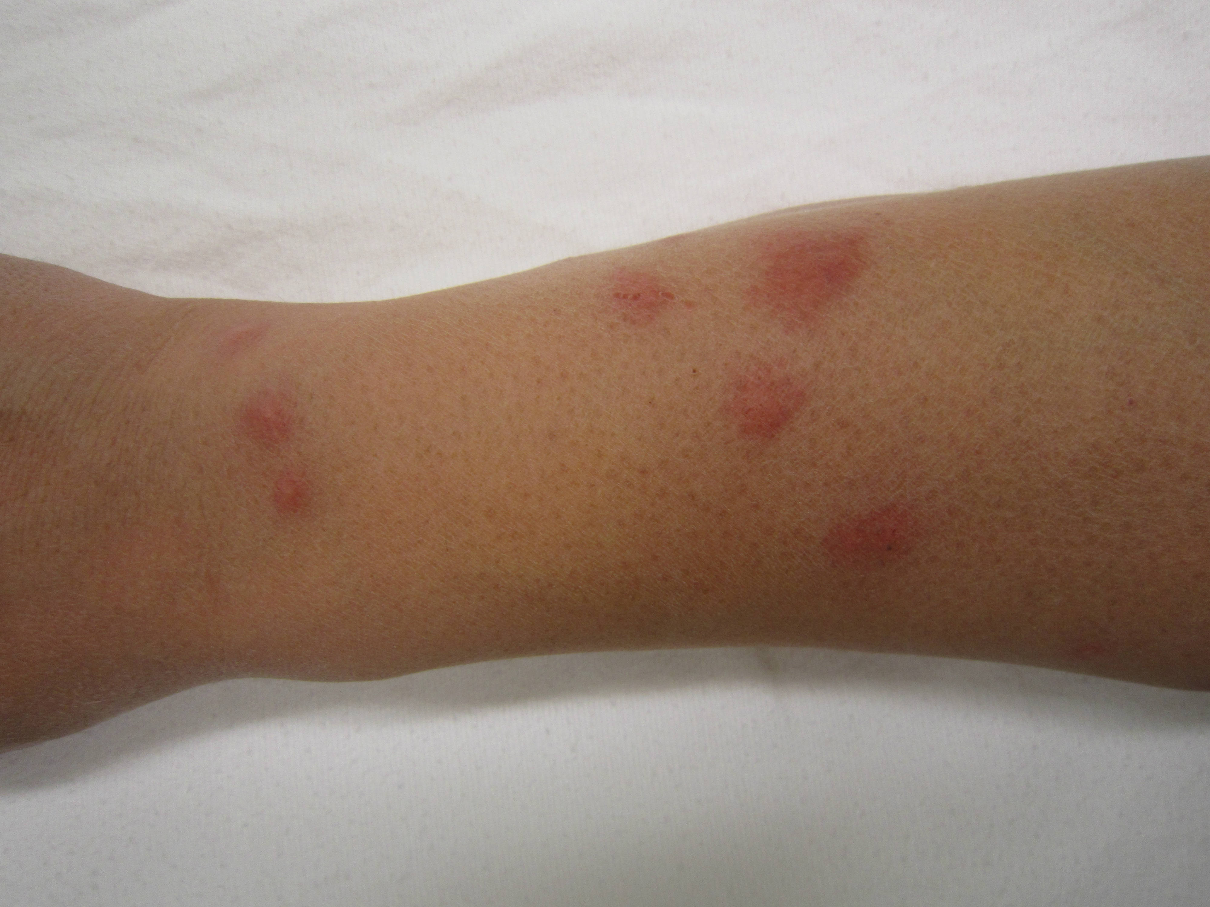 Chigger Bites Vs Bed Bug Bites