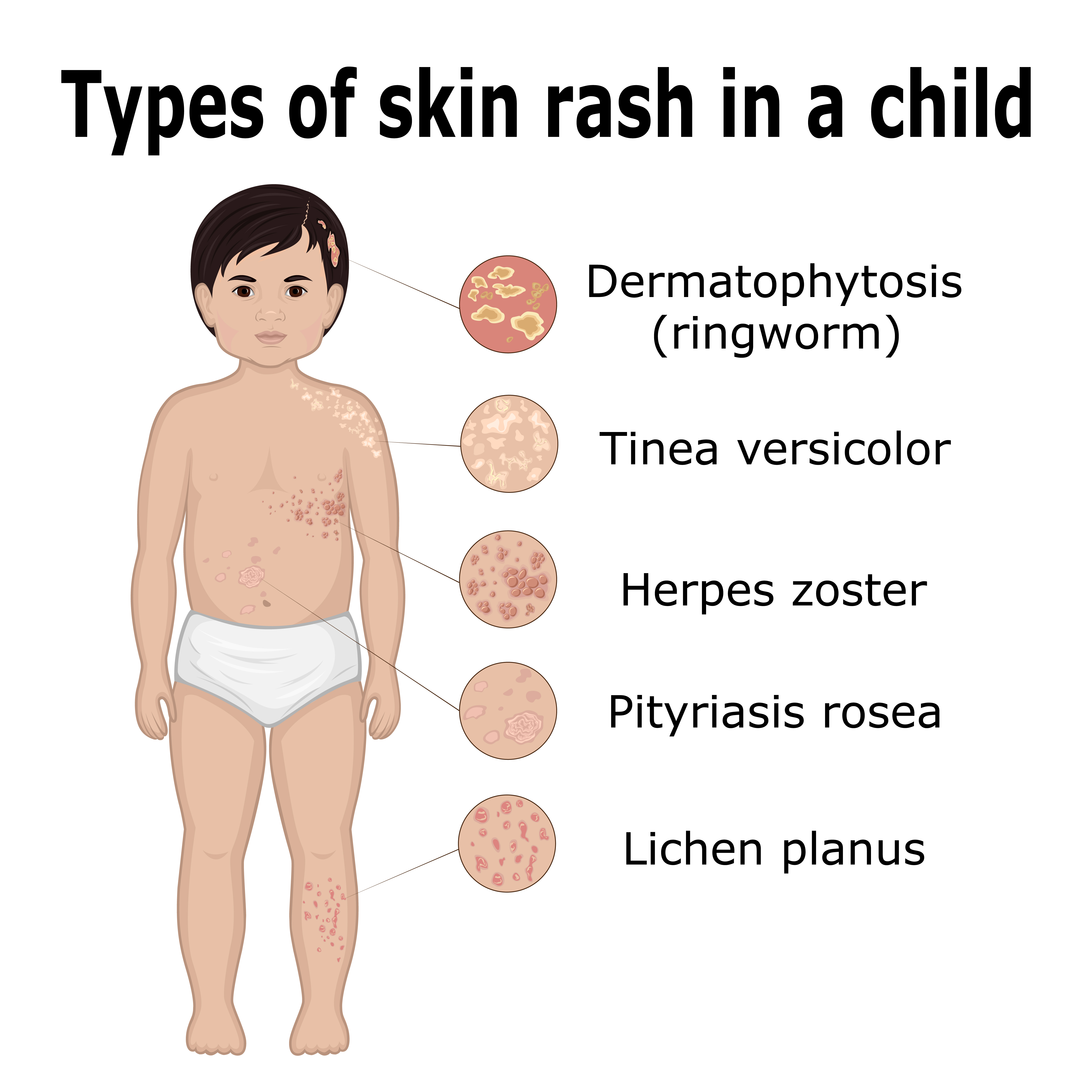 Child Skin Rash Types - Treatment @ MDIMC
