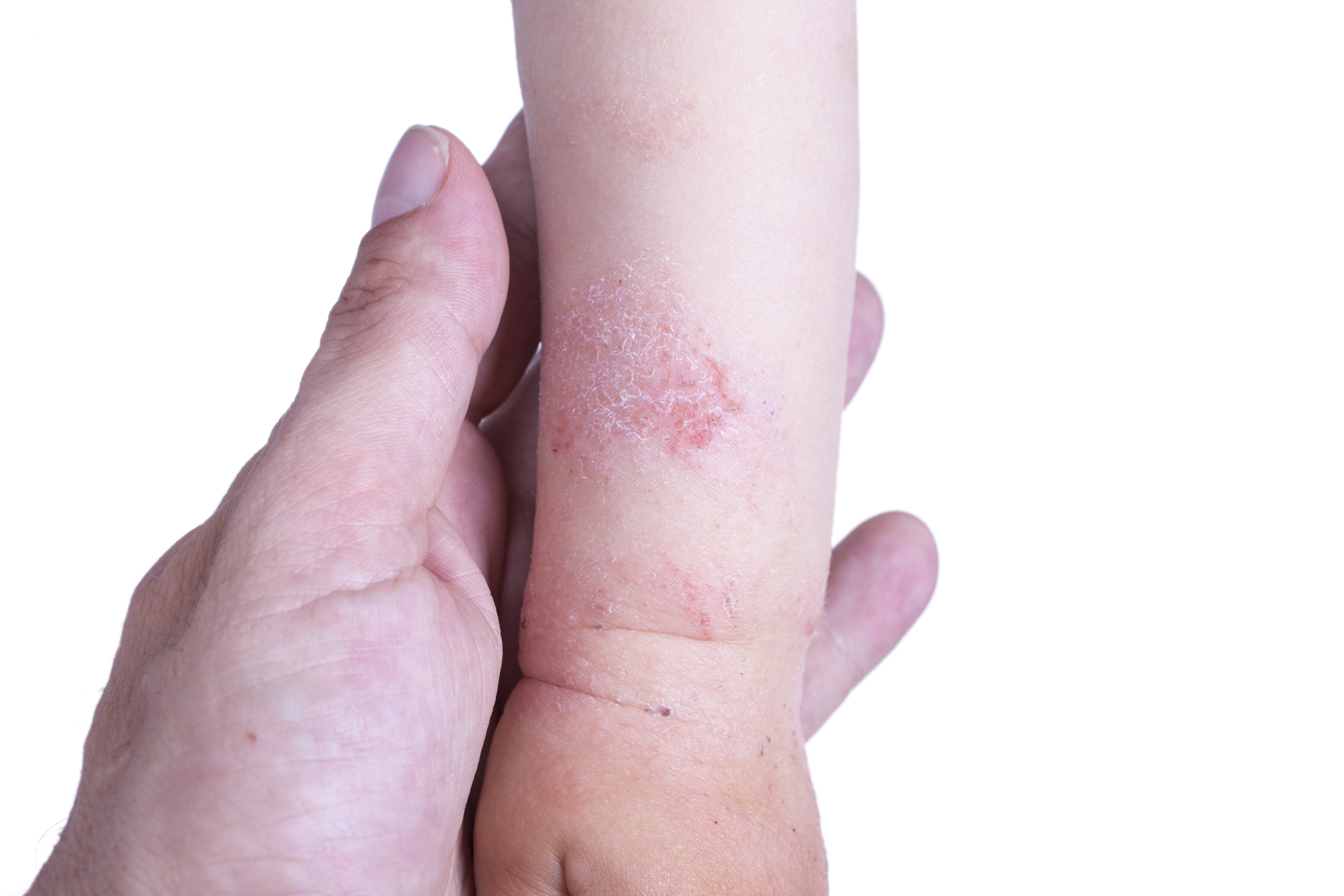 Eczema - Dermatology Treatment @ MDIMC