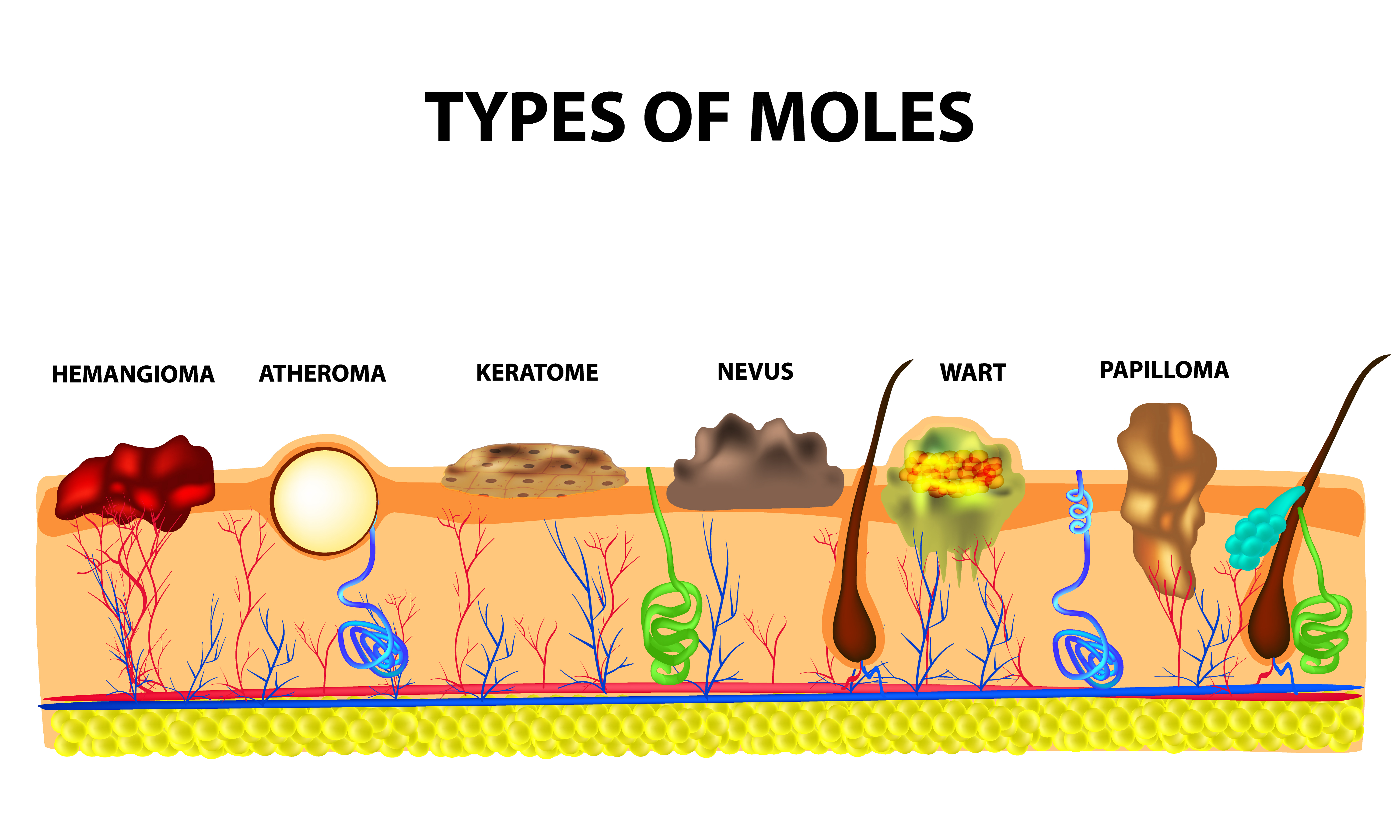 Moles - Dermatology Treatment @ MDIMC