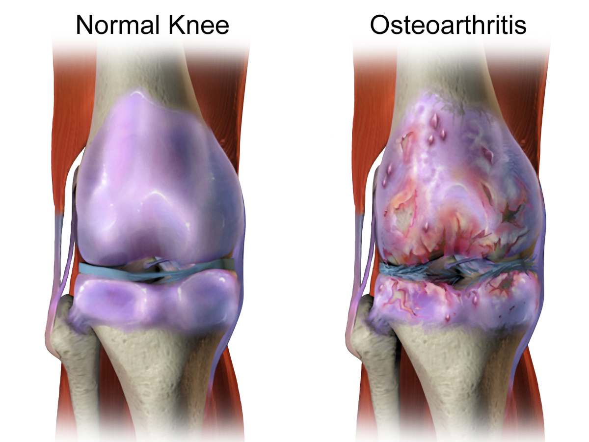 normal tramadol dosage for osteoarthritis