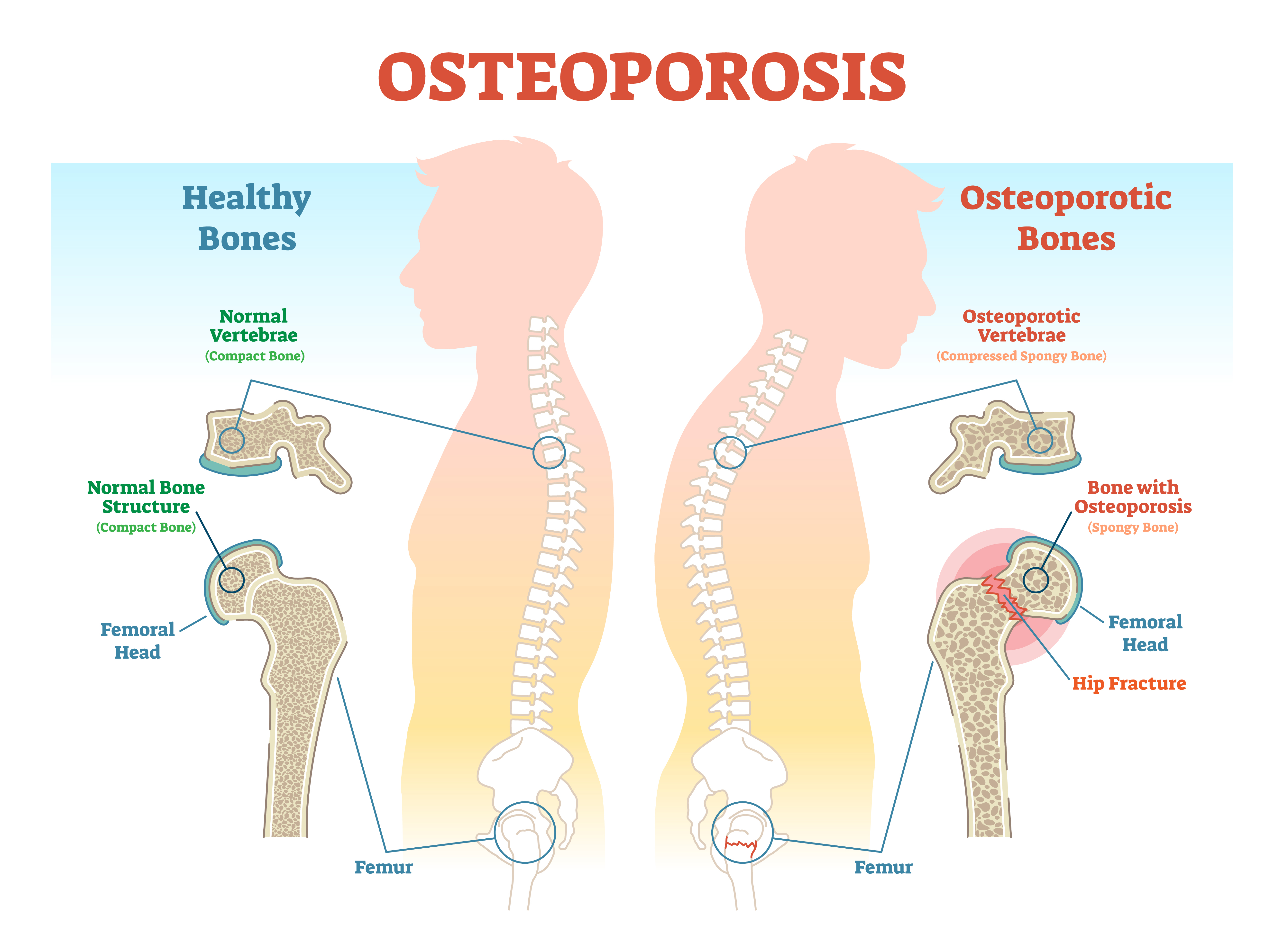 Osteoporosis - Health Screening @ MDIMC