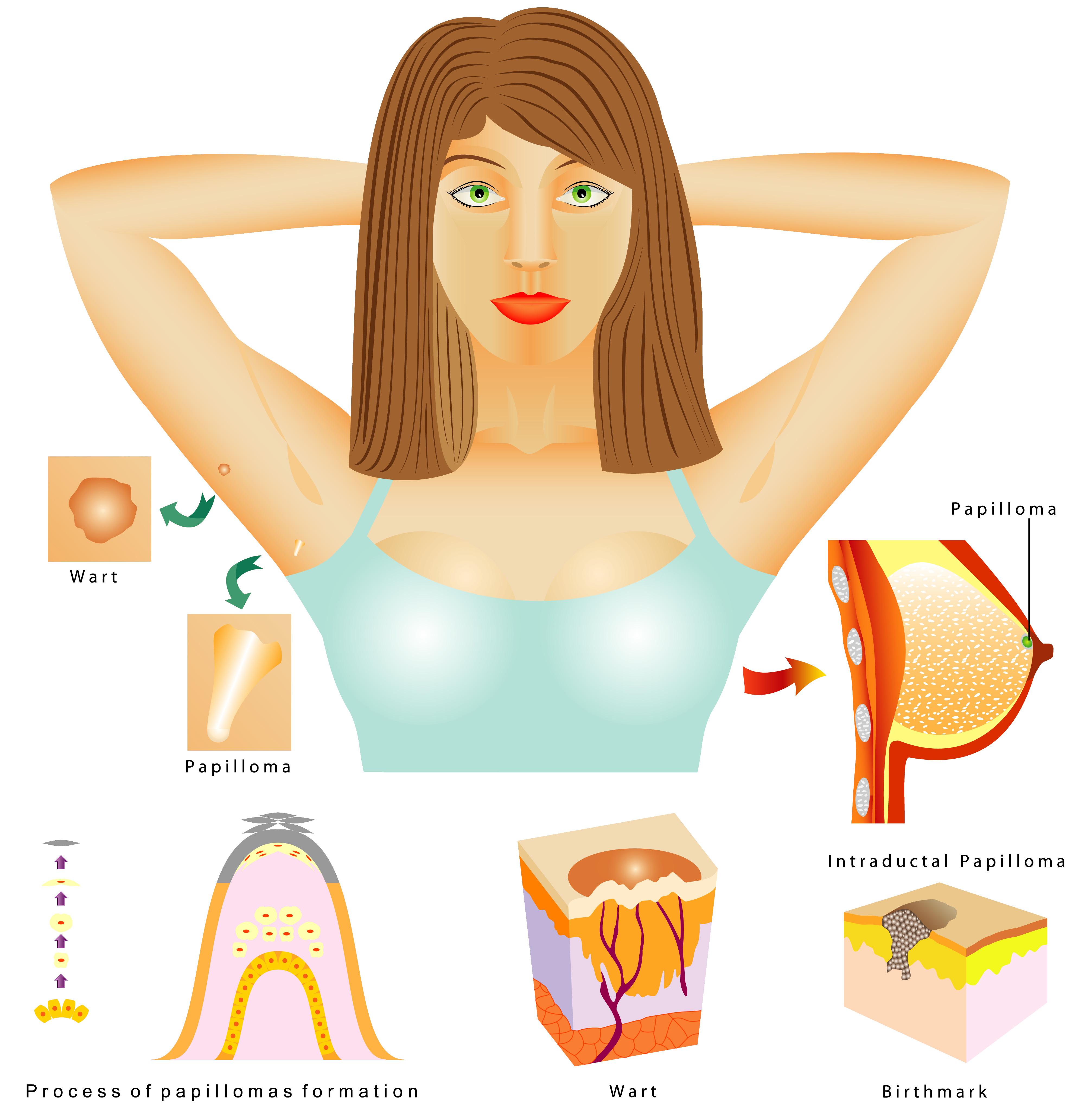 Papillomas & Warts - Treatment @ MDIMC