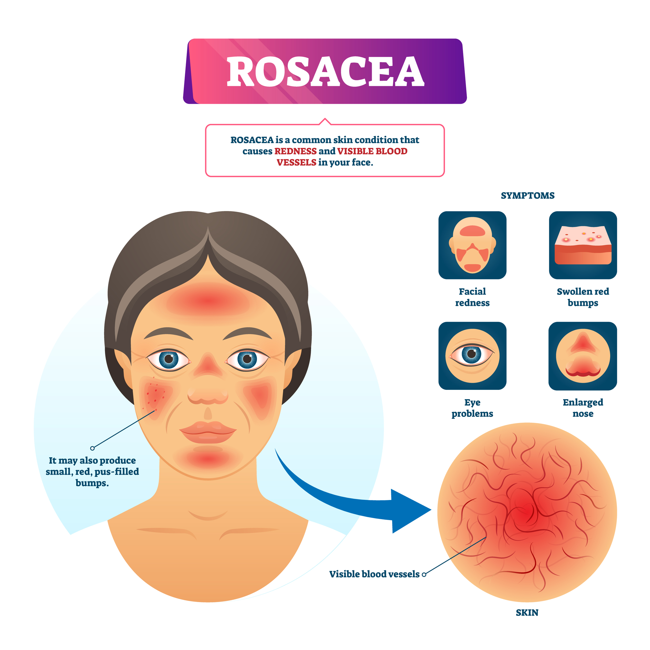 Rosacea Symptoms - Treatment @ MDIMC