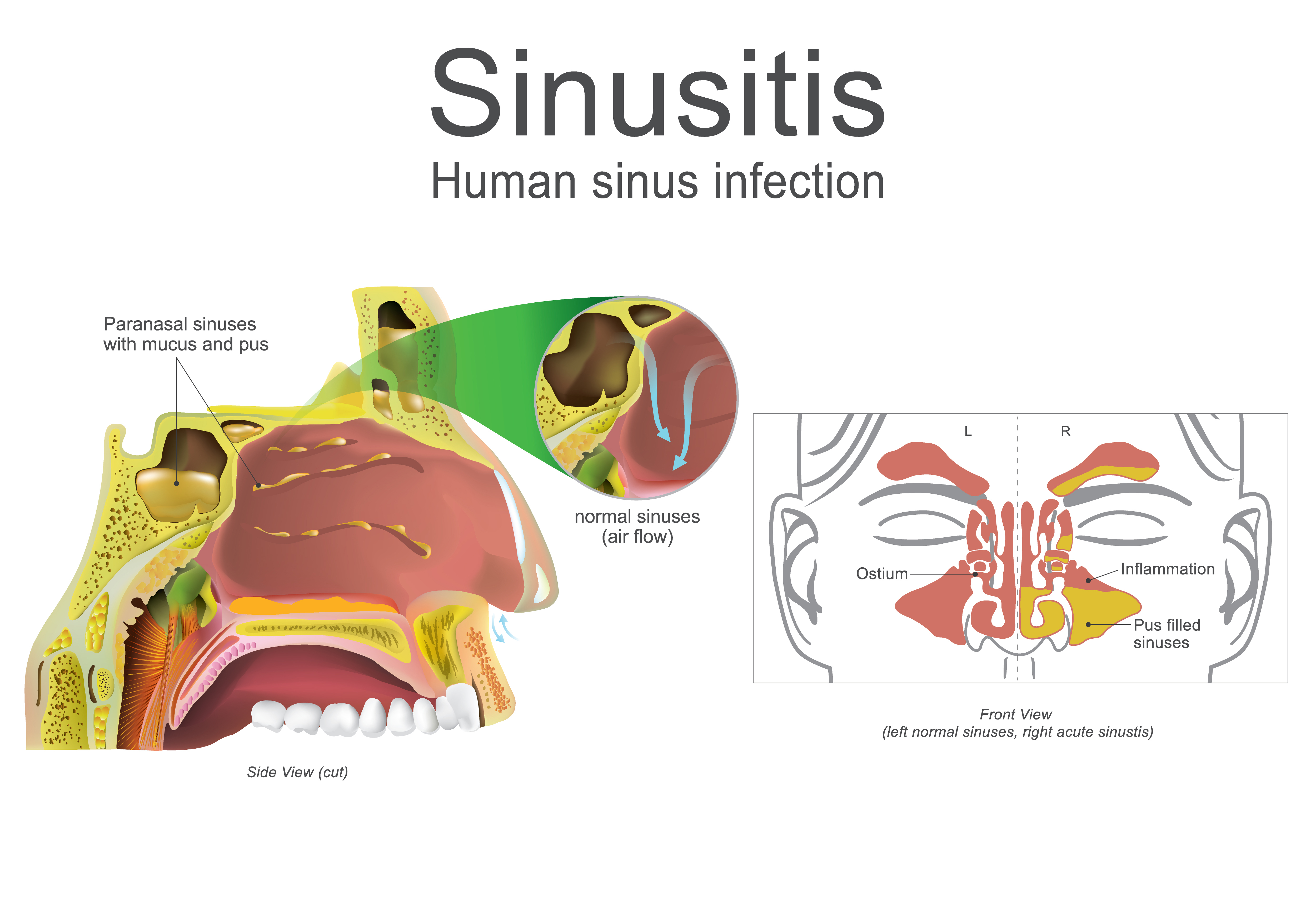 Sinusitis Infection - Treatment @ MDIMC