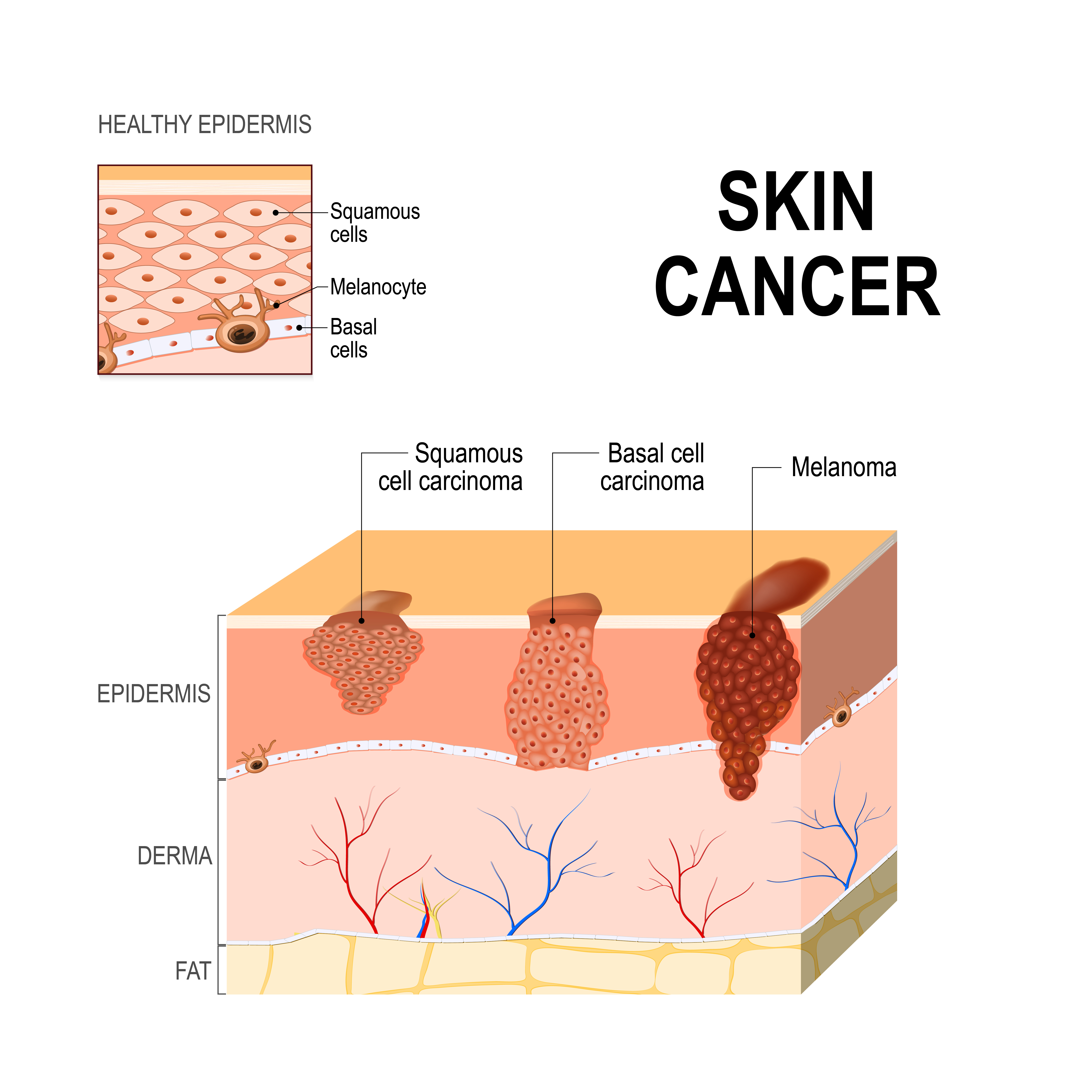 Skin Cancer / Carcinoma Treatment - MDIMC