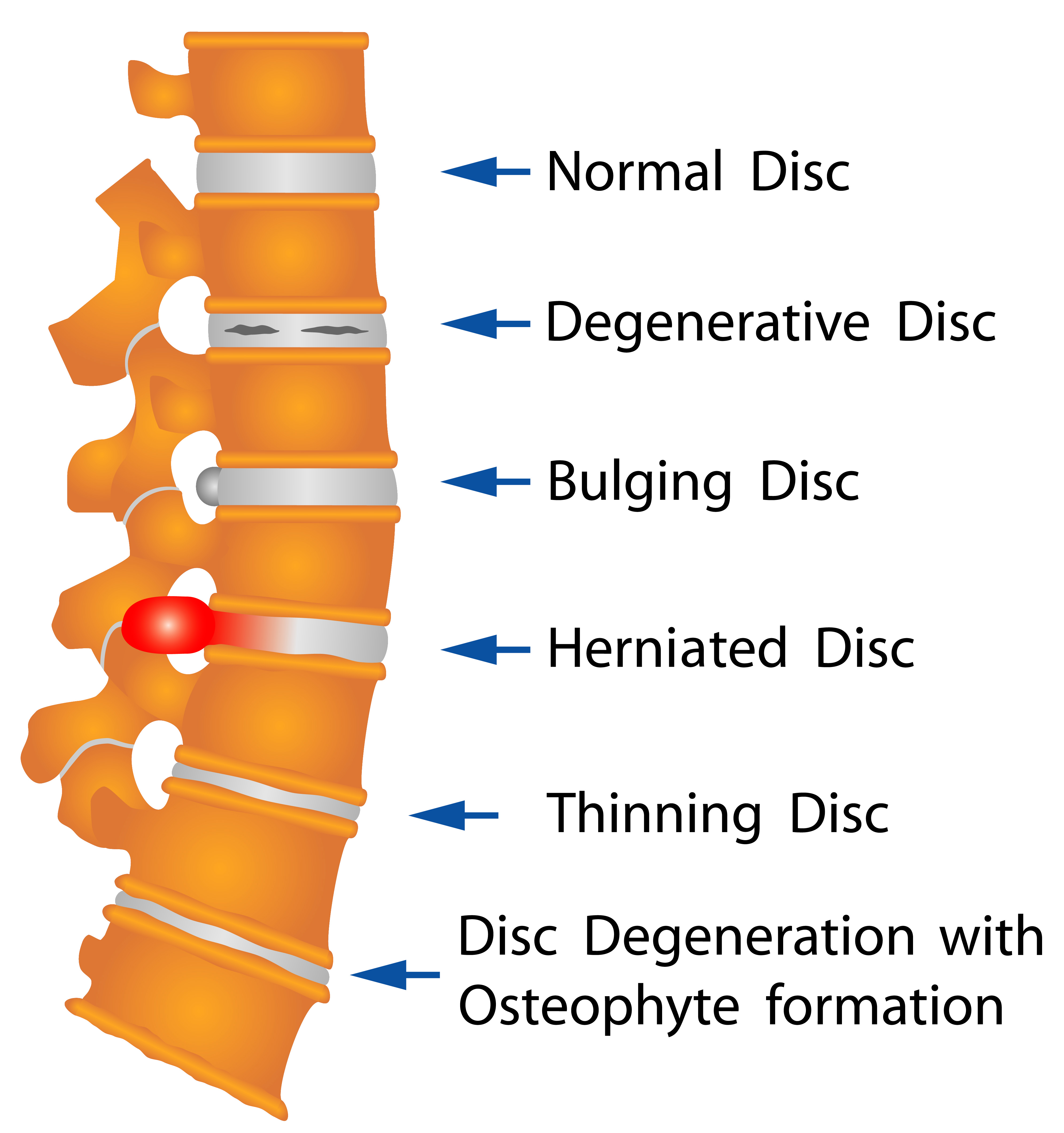 Spine Disc Degeneration Types - Treatment @ MDIMC