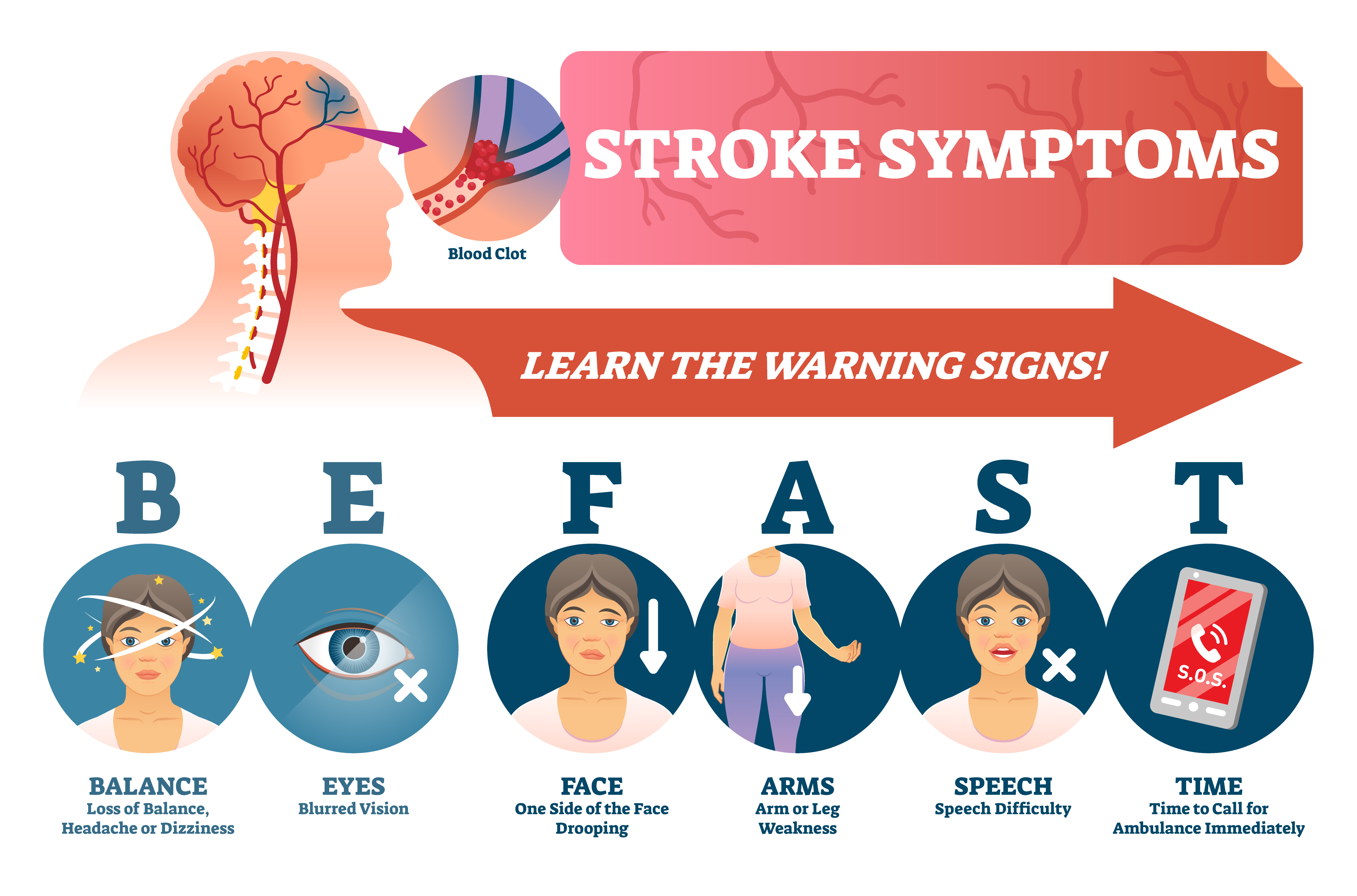 Stroke Symptoms - MDIMC