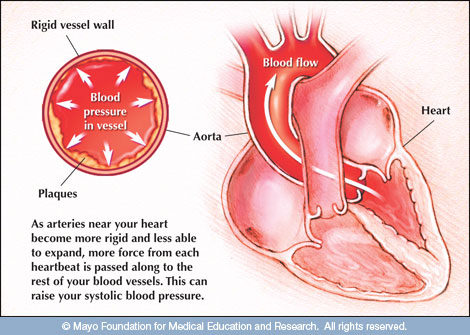 High blood pressure