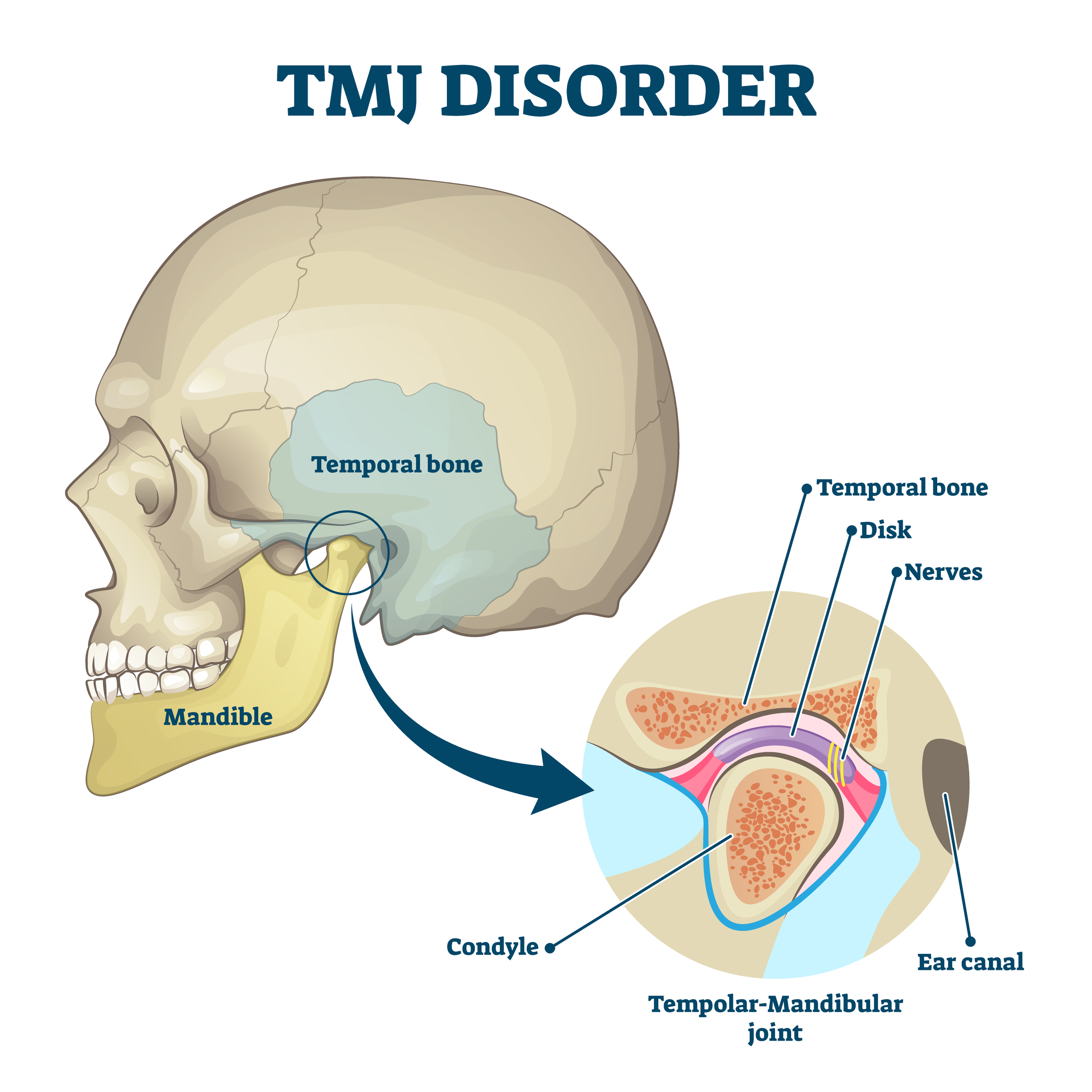 TMJ Disorder - Treatment @ MDIMC