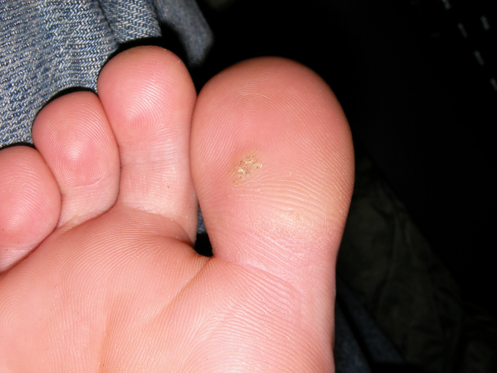 Corns, Calluses &amp; Warts on Feet