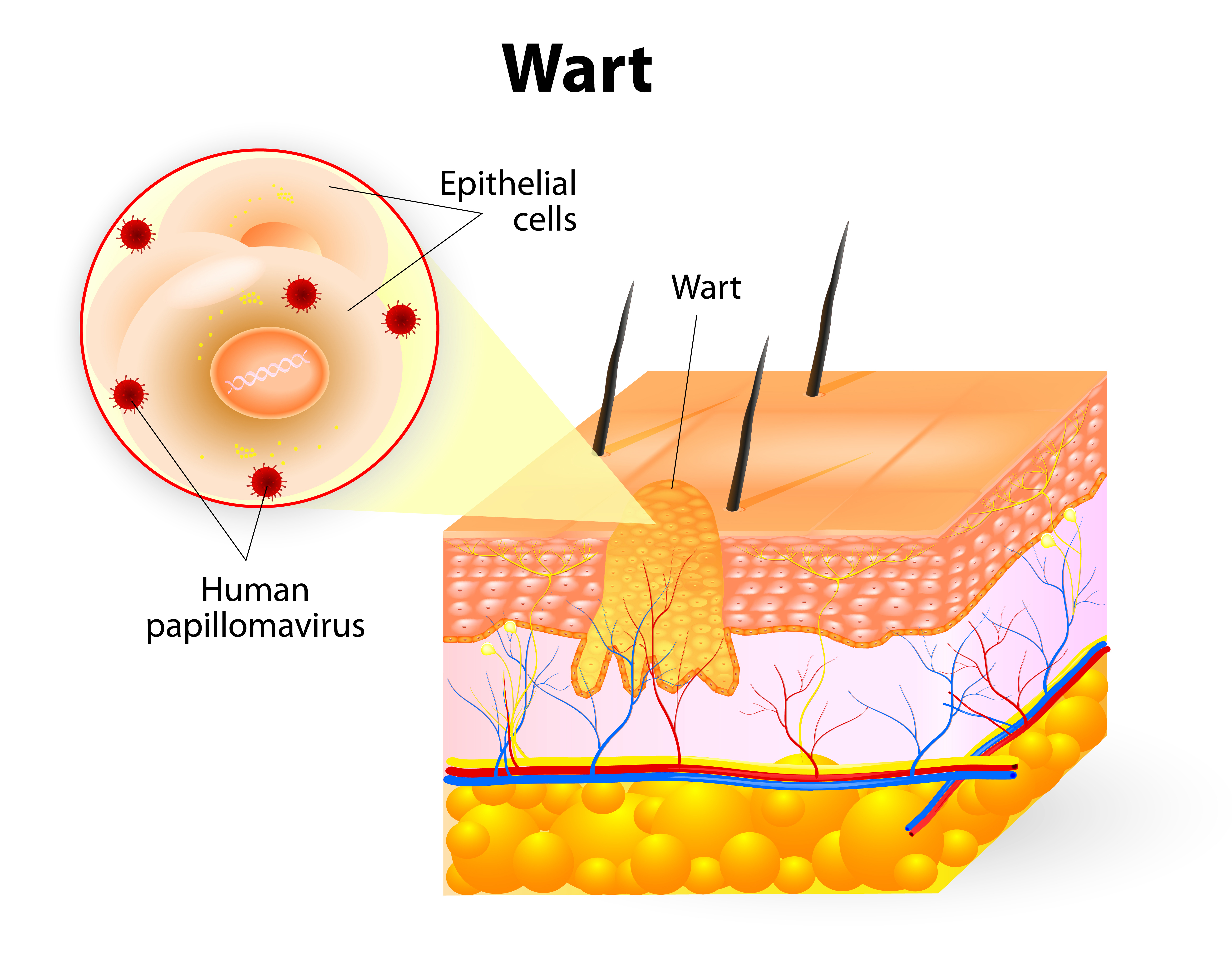 Warts - Dermatology Treatment @ MDIMC