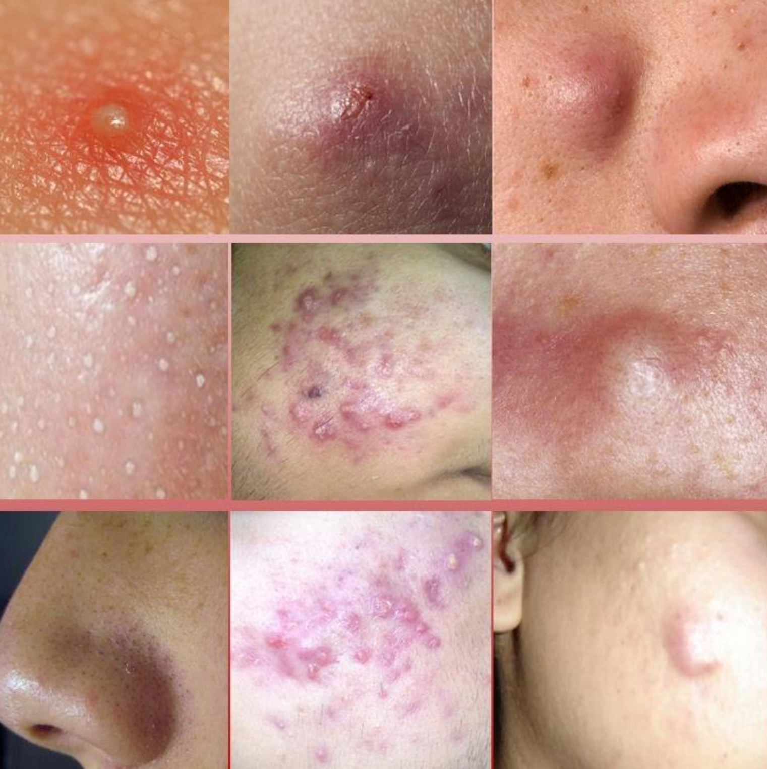 acne nodule vs cyst