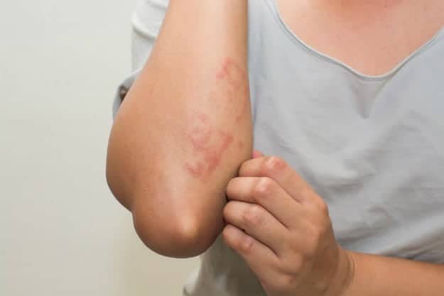 Allergic skin rash - Dermatitis Treatment @ MDIMC