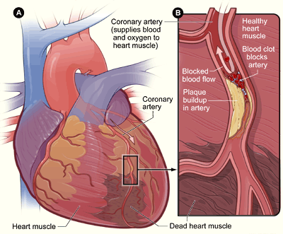 Blocked coronary arteries