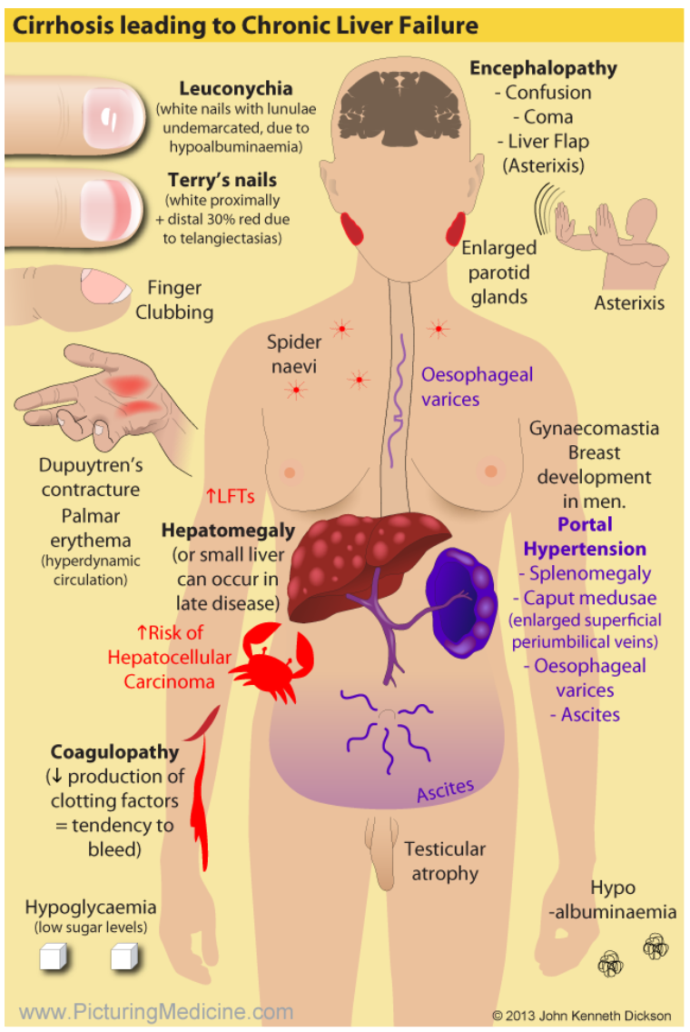 liver cirrhosis symptoms