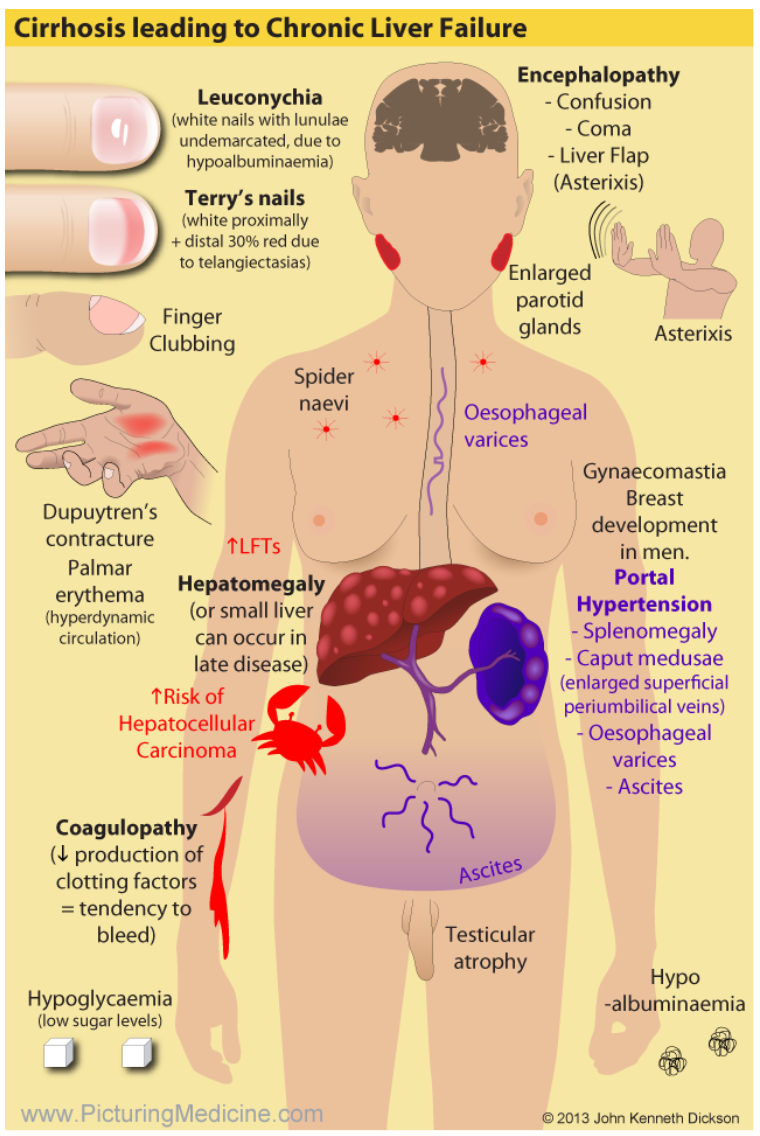 Liver Disease Diet For Health