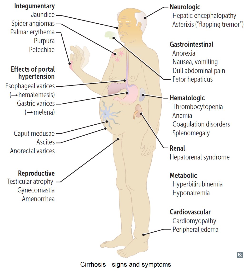 liver cirrhosis symptoms