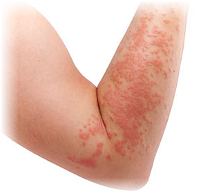 Contact Dermatitis due to Allergy