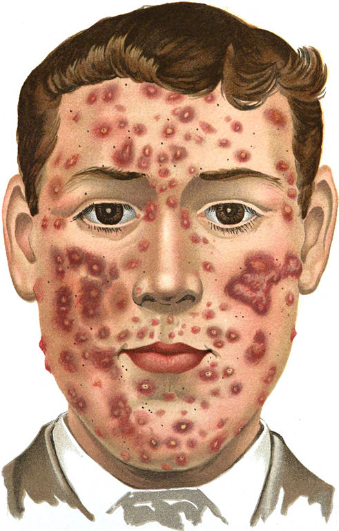 Pimples, Blemish or Acne Treatment - Seek a Doctor or Dermatologist