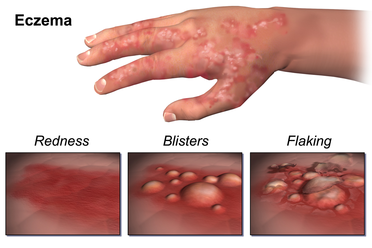 Fingers & Toes: Skin Rash - I cannot get a diagnosis ...