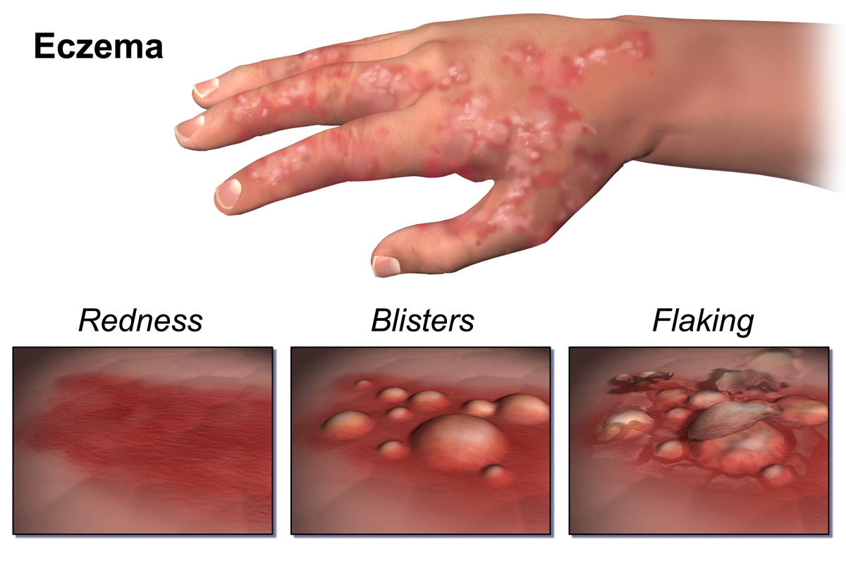 Dyshidrotic Eczema - Pictures, Treatment, Causes ...