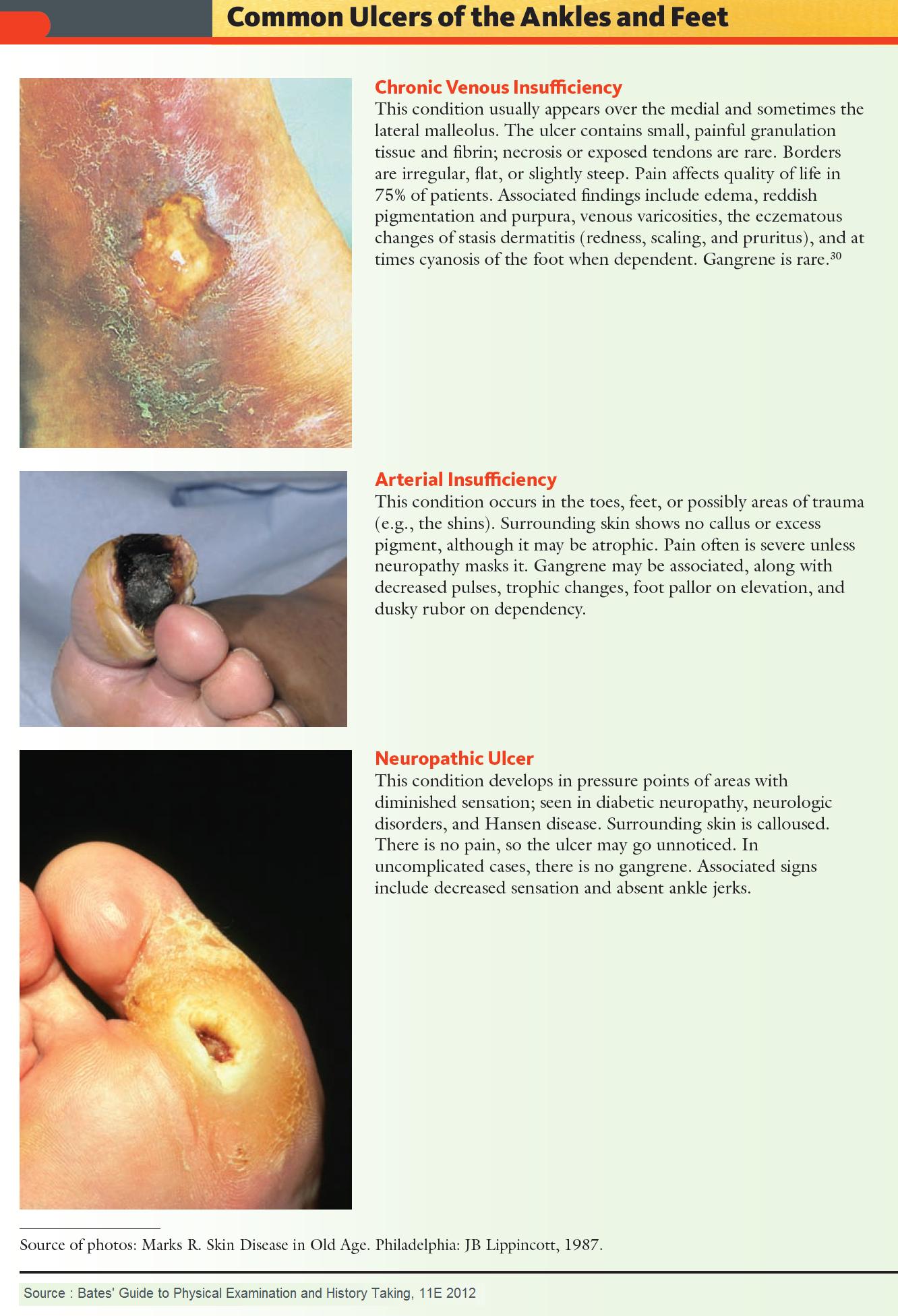 Foot Ulcers