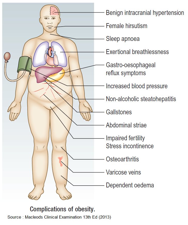 Obesity Complications - Lose weight safely at AMDA SG Tel: 6694 1661