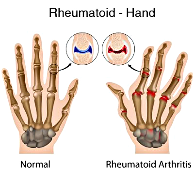 Rheumatoid Arthritis in the Hand - Pain in the small joints