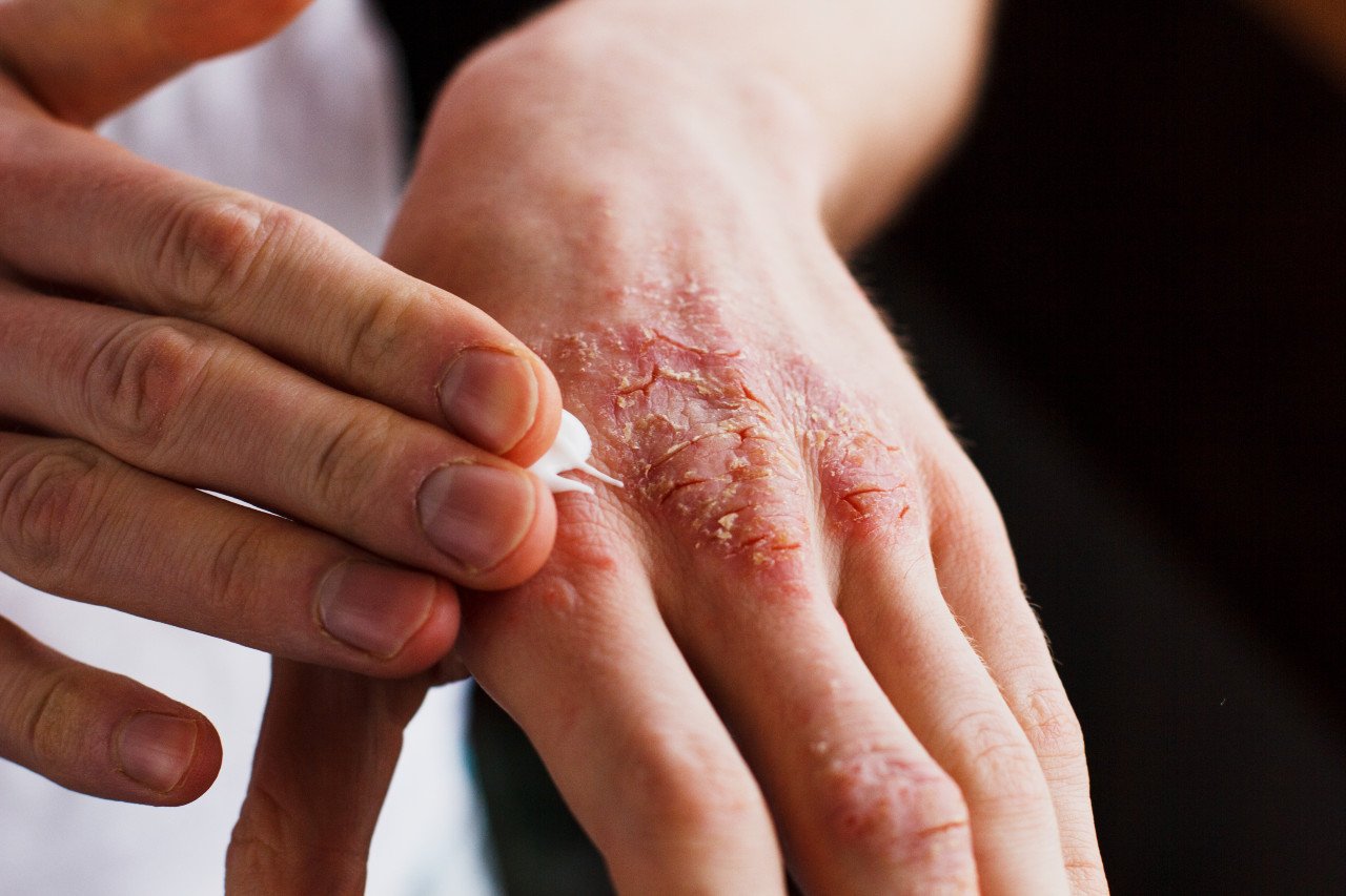 AMDA Clinic- Best Dermatology doctor Eczema Psoriasis treatment dry skin hand