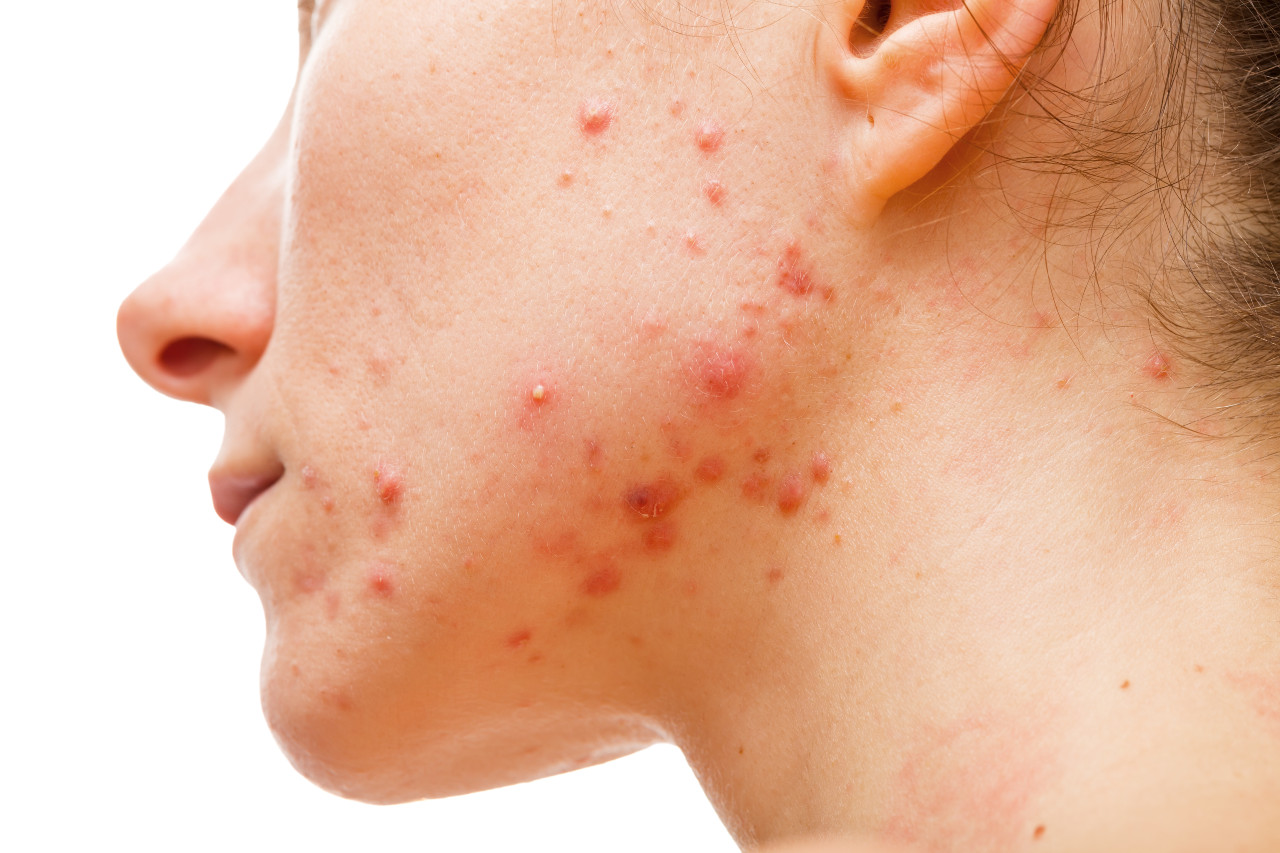 Acne & Pimples - Dermatology Treatment @ MDIMC