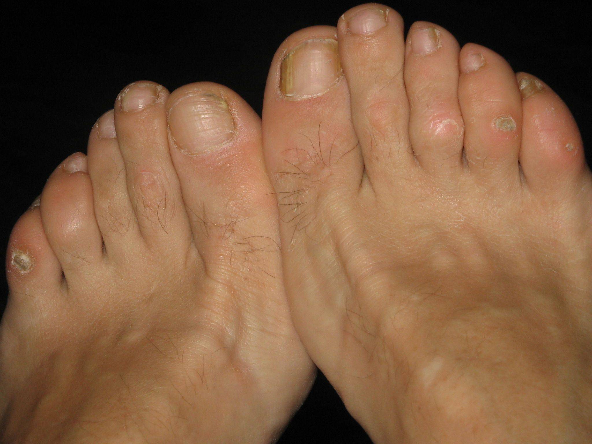 Corns, Calluses & Warts on Feet