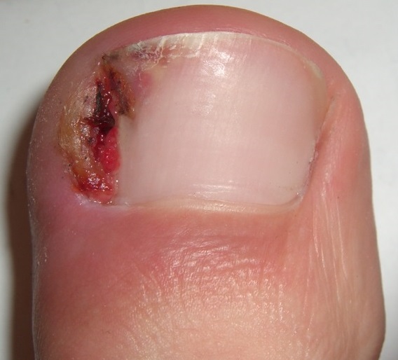 Treatment of Ingrown nail at AMDA SG Tel: 6694 1661